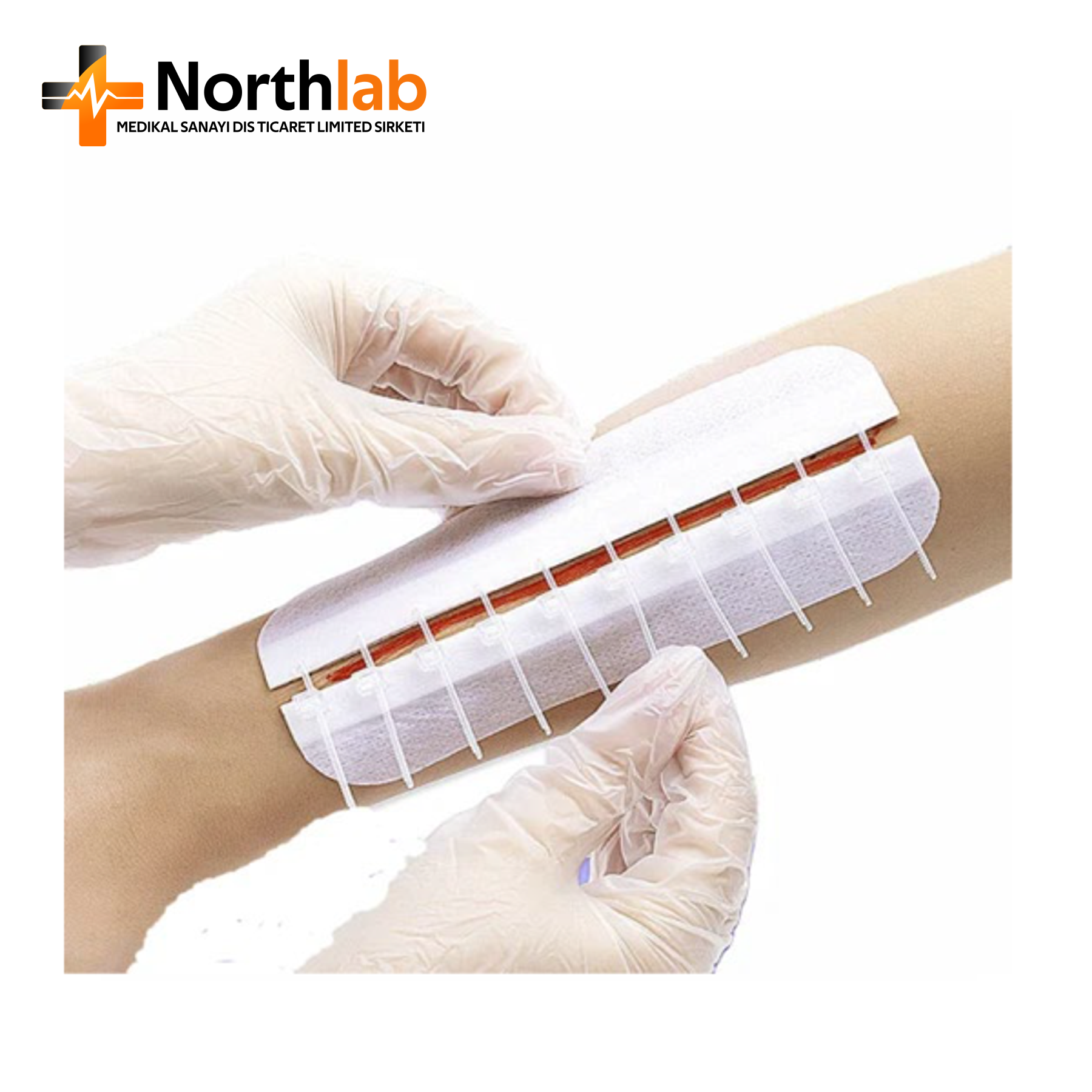 Wound Zipper Closure Device